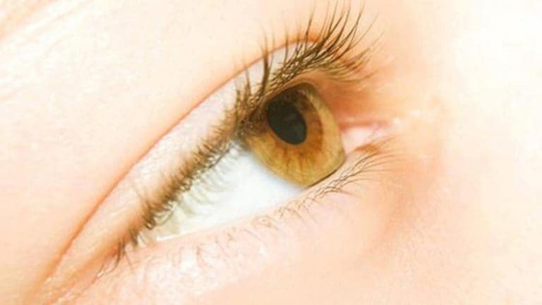 اسباب اصفرار العين والبول وأعراض كلا منهما