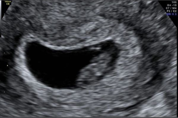 شكل الجنين الذكر في الشهر الثاني