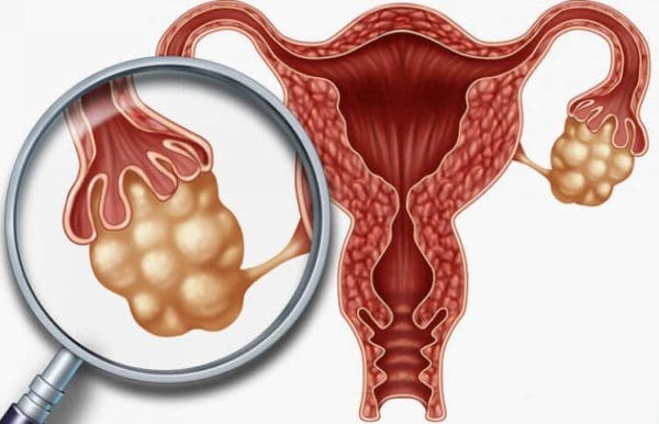 علاج تليف الرحم بالثوم وأسباب حدوثه وأعراضه