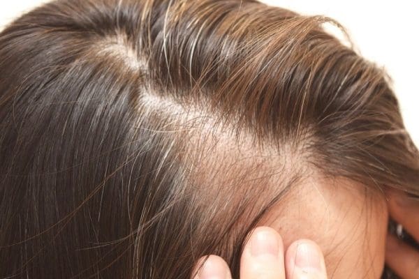 Treating hair follicle blockage