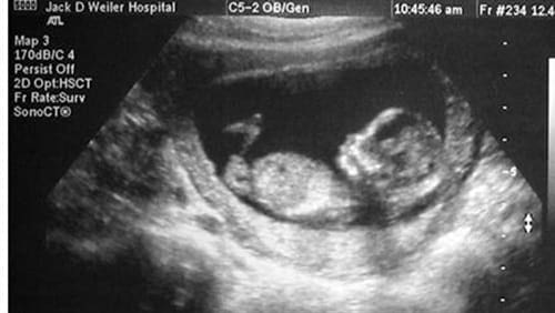 شكل الجنين الذكر في الشهر الثاني بالسونار ومراحل تطوره زيادة