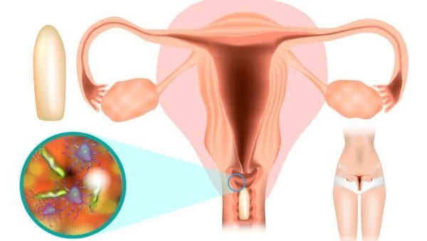 علاج حكة المهبل للحامل