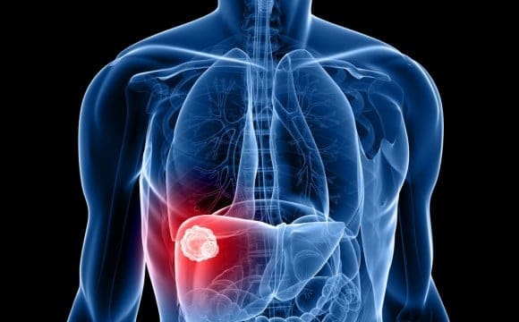 كم يعيش مريض سرطان الكبد المرحلة الرابعة
