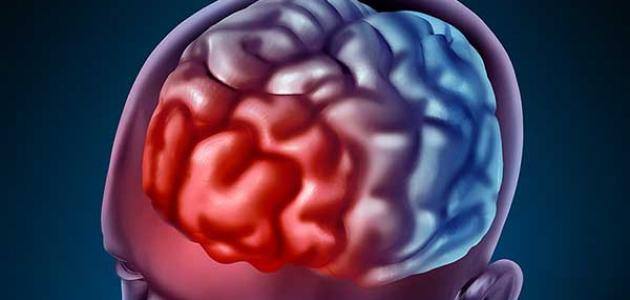 نسبة نجاح عمليات نزيف المخ