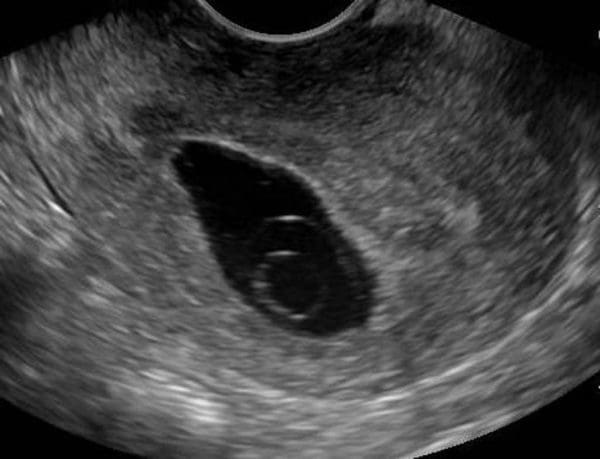 الفرق بين كيس الحمل وكيس الدورة ومتى يظهر الجنين في كيس الحمل؟