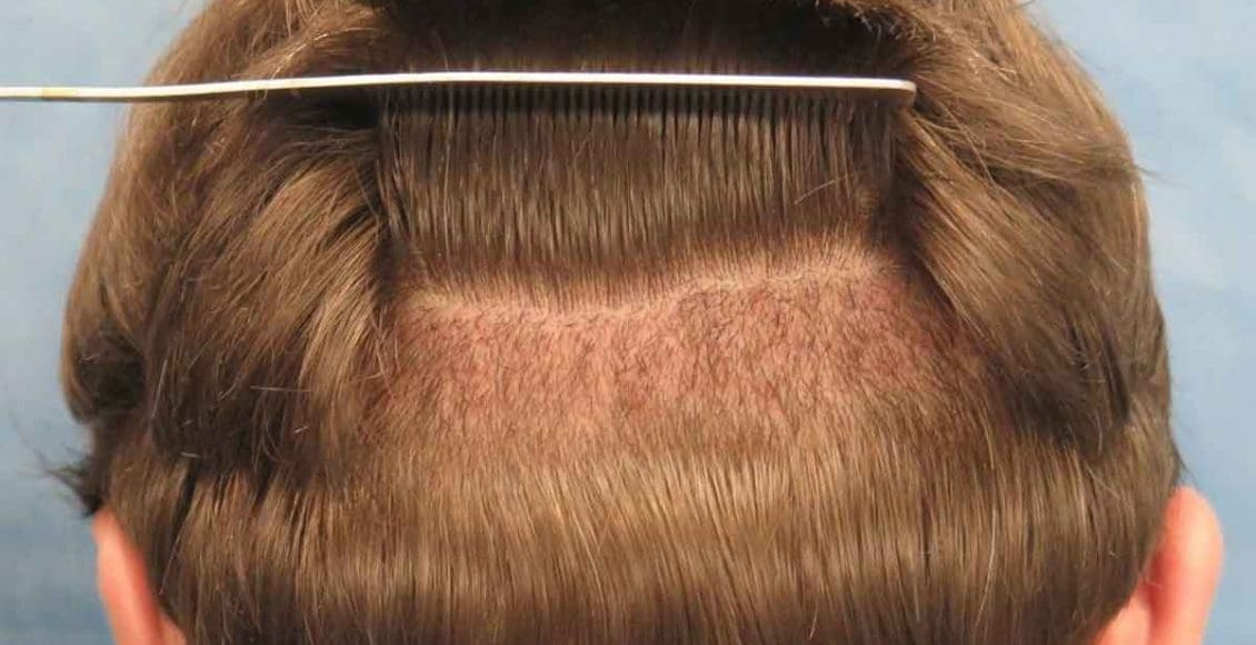 كم يستغرق نمو شعر الرأس