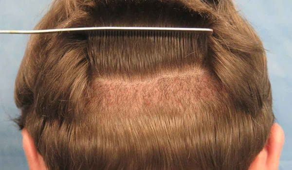 كم يستغرق نمو شعر الرأس وما العوامل المؤثرة في زيادة طول الشعر زيادة