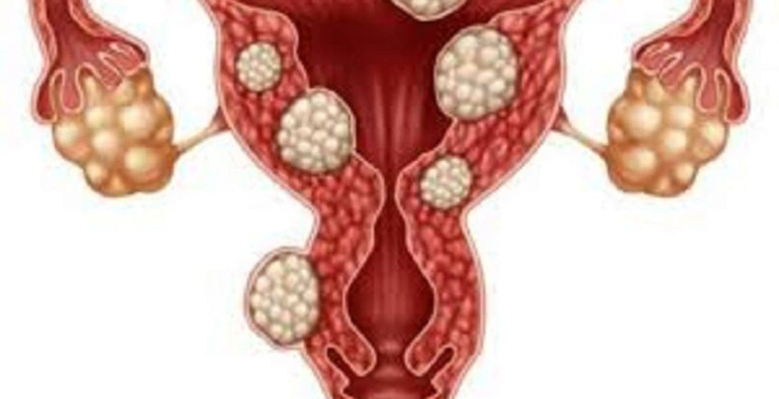أعراض الورم الليفي في الرحم