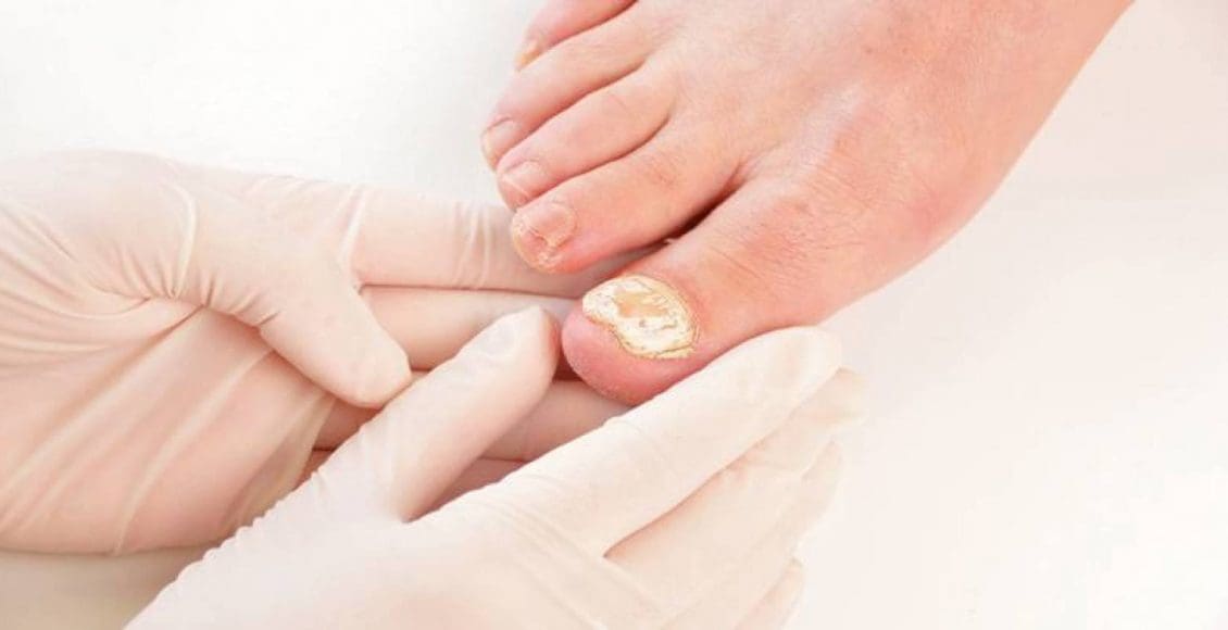 علاج أظافر القدم السميكة