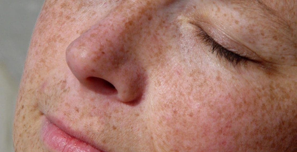 علاج البقع البنية في الوجه بالأعشاب