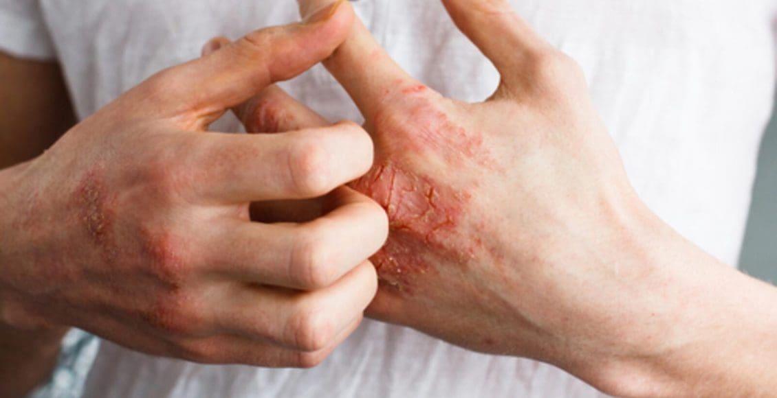 علاج حساسية الجلد من الكلور