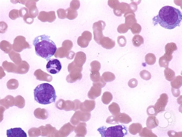 ما معنى monocytes في تحليل الدم؟