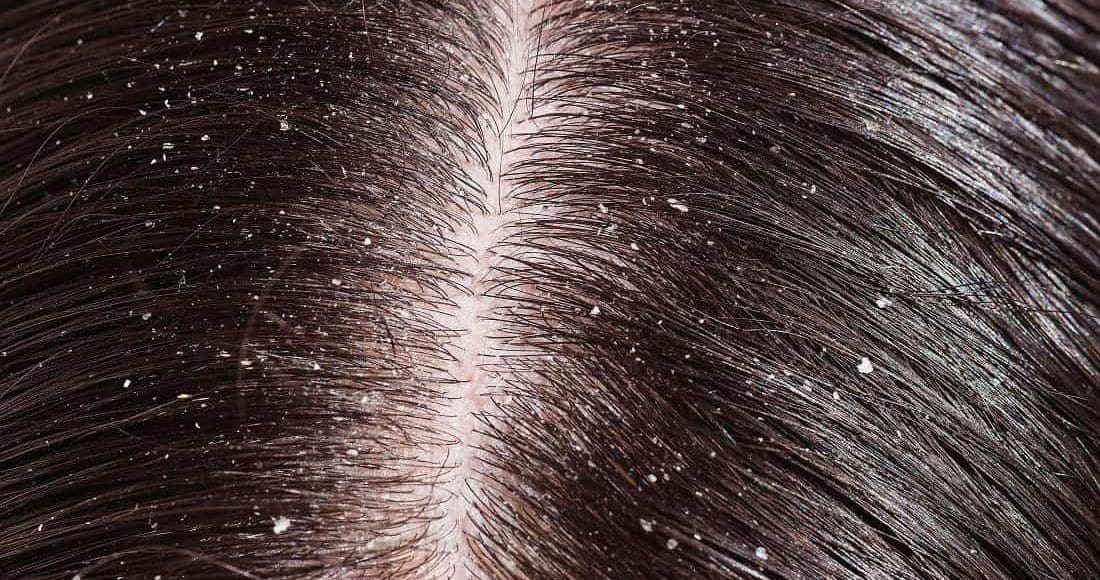 أنواع قشرة الشعر بالصور