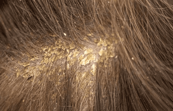 أنواع قشرة الشعر بالصور