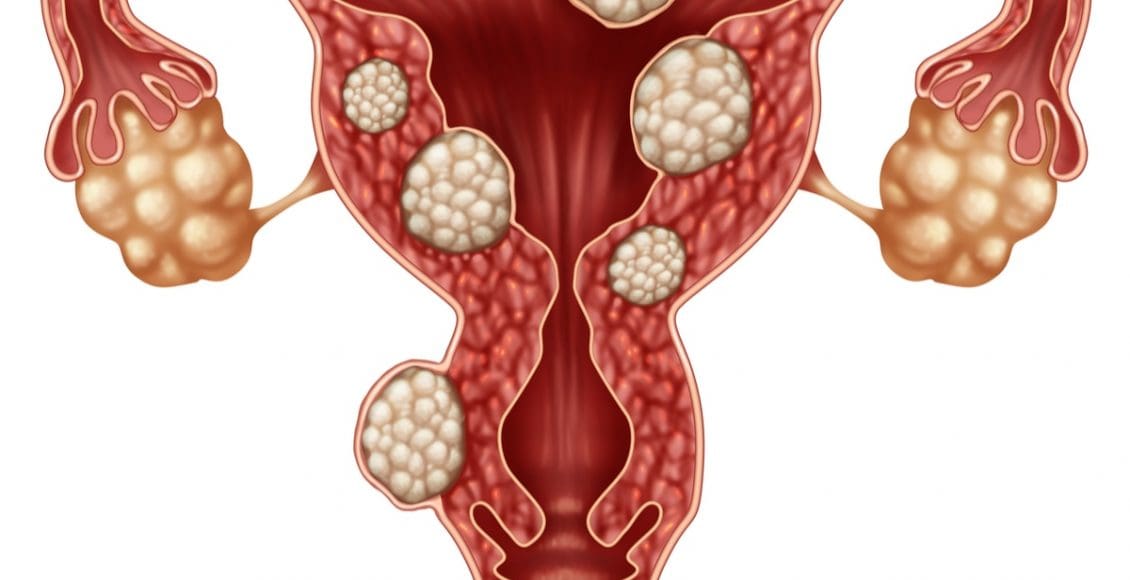 اعراض الورم الليفي في الرحم