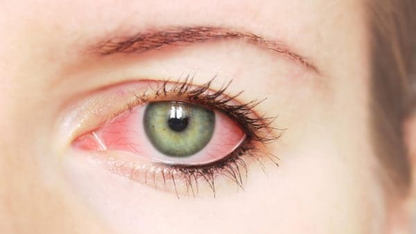 أعراض ارتفاع ضغط العين وعلاجه وأسبابه
