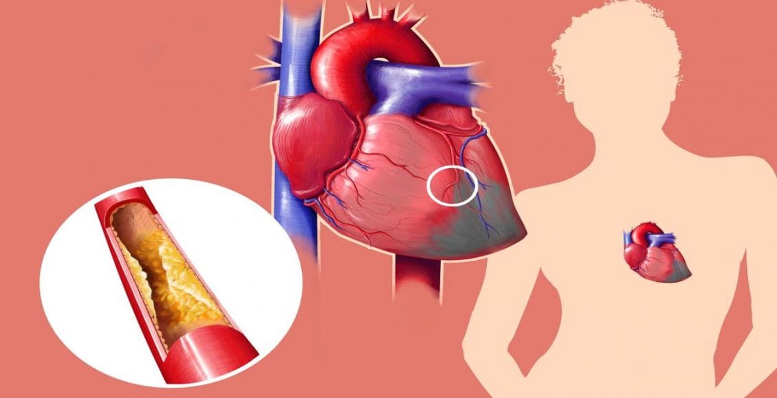 أعراض الأزمة القلبية عند النساء وأسبابها وعلاجها