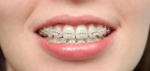 معلومات عن تقويم الأسنان 
