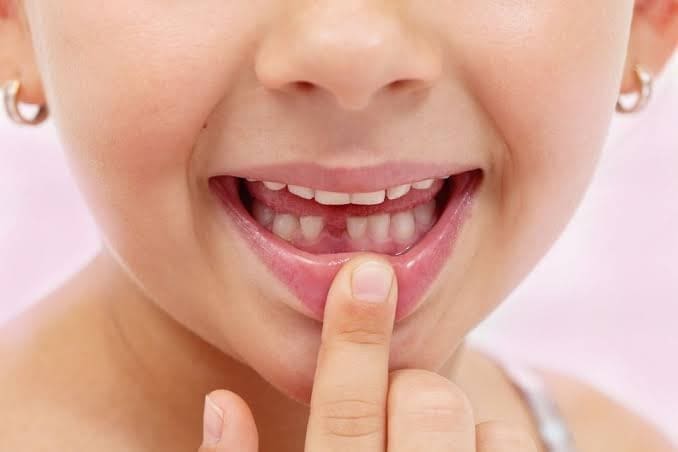 سقوط الأسنان اللبنية في عمر خمس سنوات