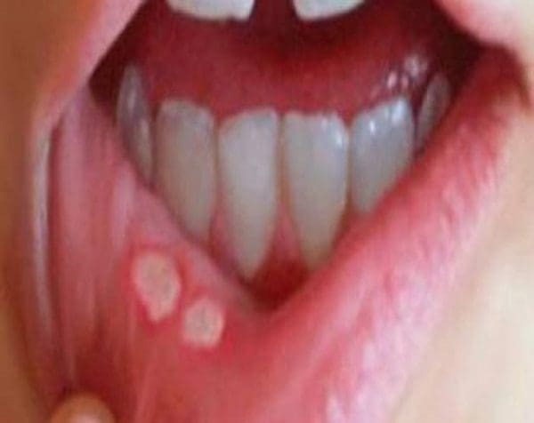 علاج الحمو داخل الفم بطرق طبيعية