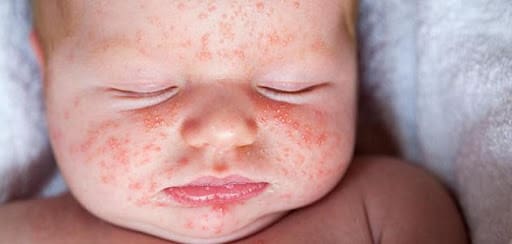 الفرق بين حساسية الحليب وحساسية اللاكتوز عند الرضع زيادة