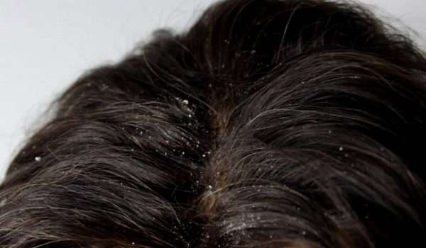 بروتين نفس الشيء الوعظ  علاج قشرة الشعر بالخل مجرب – زيادة