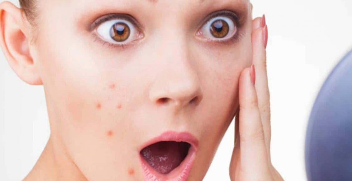 أسباب ظهور الحبوب المؤلمة في الوجه وطرق علاجها