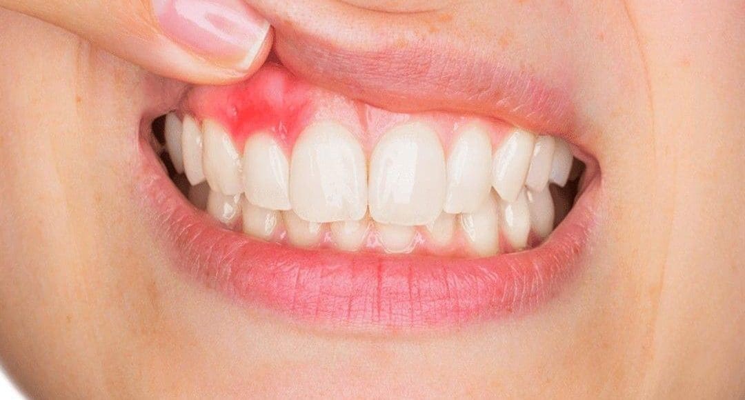 أفضل أدوية علاج التهاب اللثة والأسنان