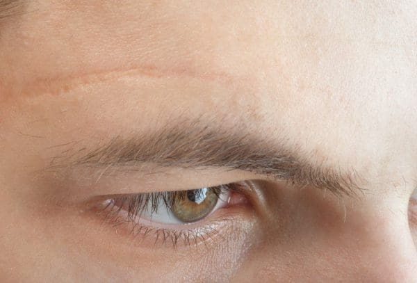 طرق علاج آثار الجروح والخدوش في الوجه