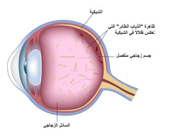 عملية الجسم الزجاجي في العين