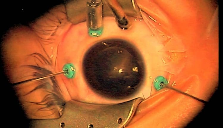 عملية الجسم الزجاجي في العين