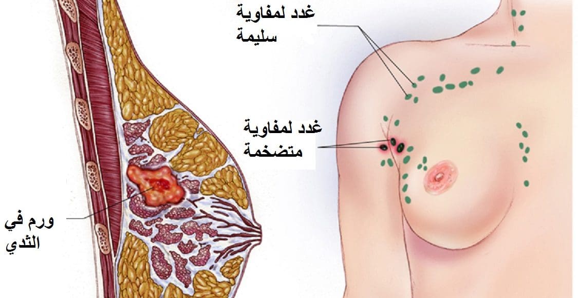 مواصفات الكتلة السرطانية في الثدي