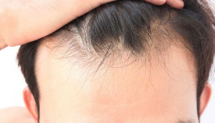 أسباب تساقط الشعر عند الشباب وعلاجه