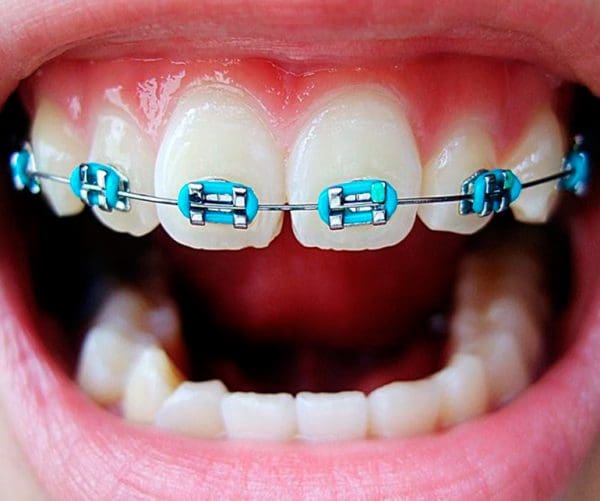بريسز اسنان