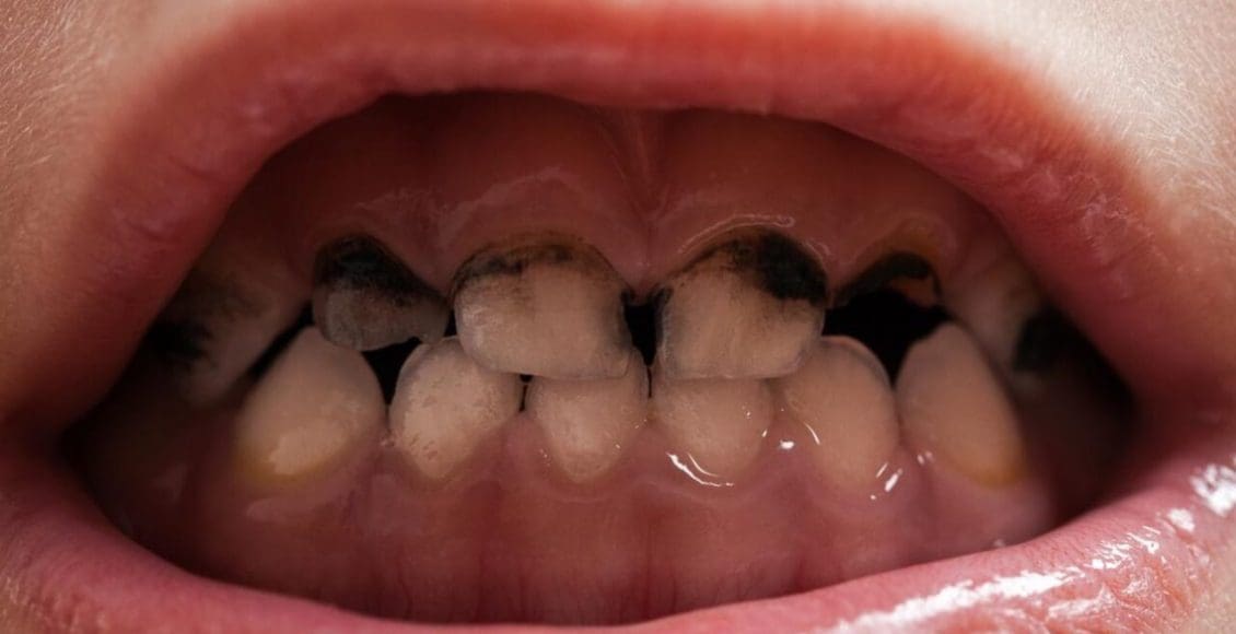 علاج تسوس الأسنان عند الأطفال وأسبابها
