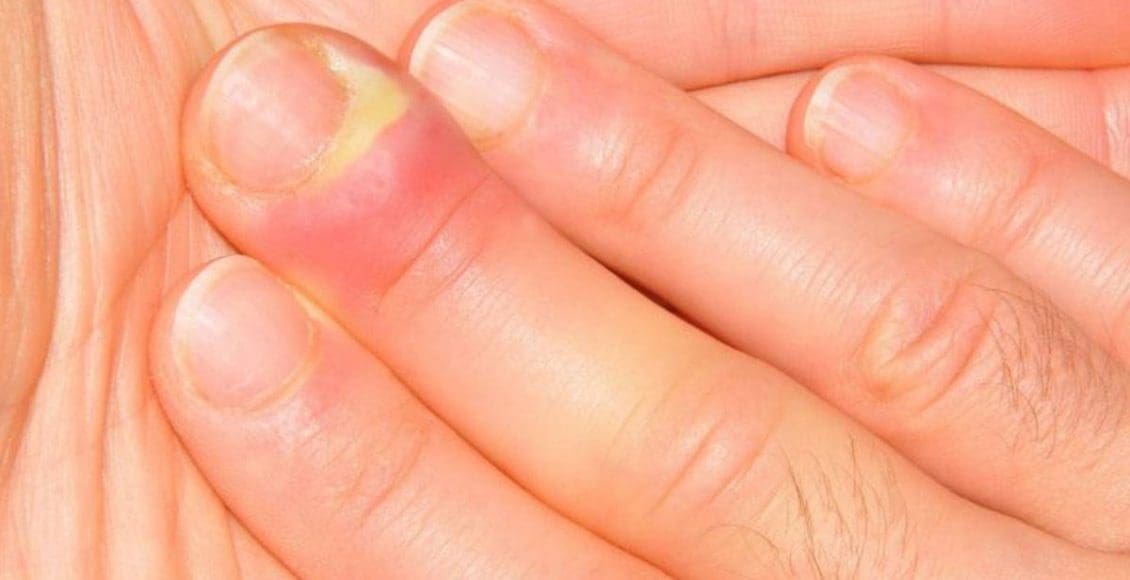 علاج الإصبع المدوحس في المنزل بطرق مجربة