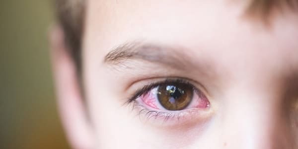 علاج احمرار العين عند الأطفال بالأعشاب