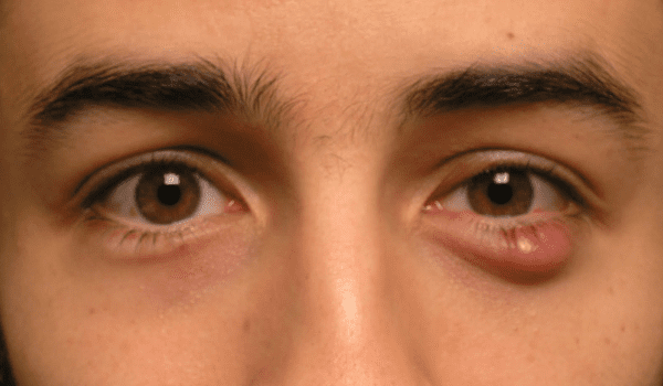 طرق علاج الكيس الدهني في العين بالثوم » زيادة