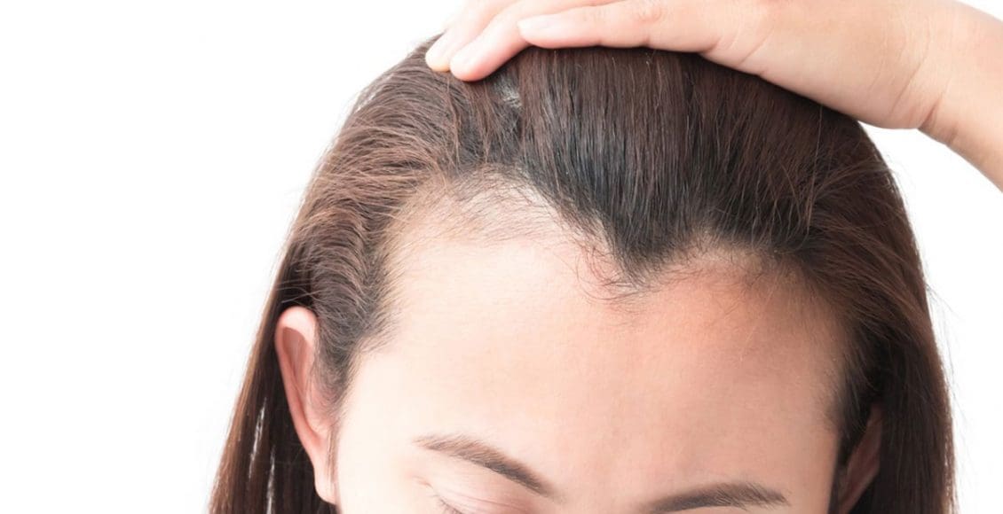 علاج تساقط الشعر الشديد عند النساء وتكثيفه