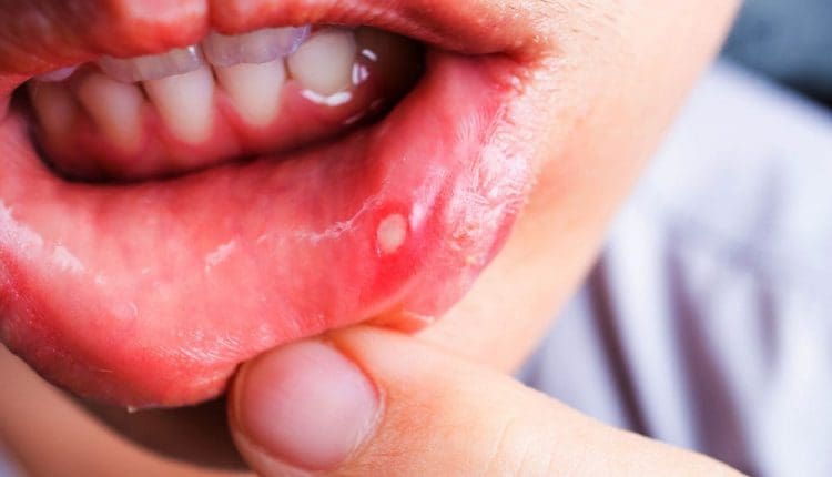 علاج تقرحات الفم عند الأطفال في المنزل