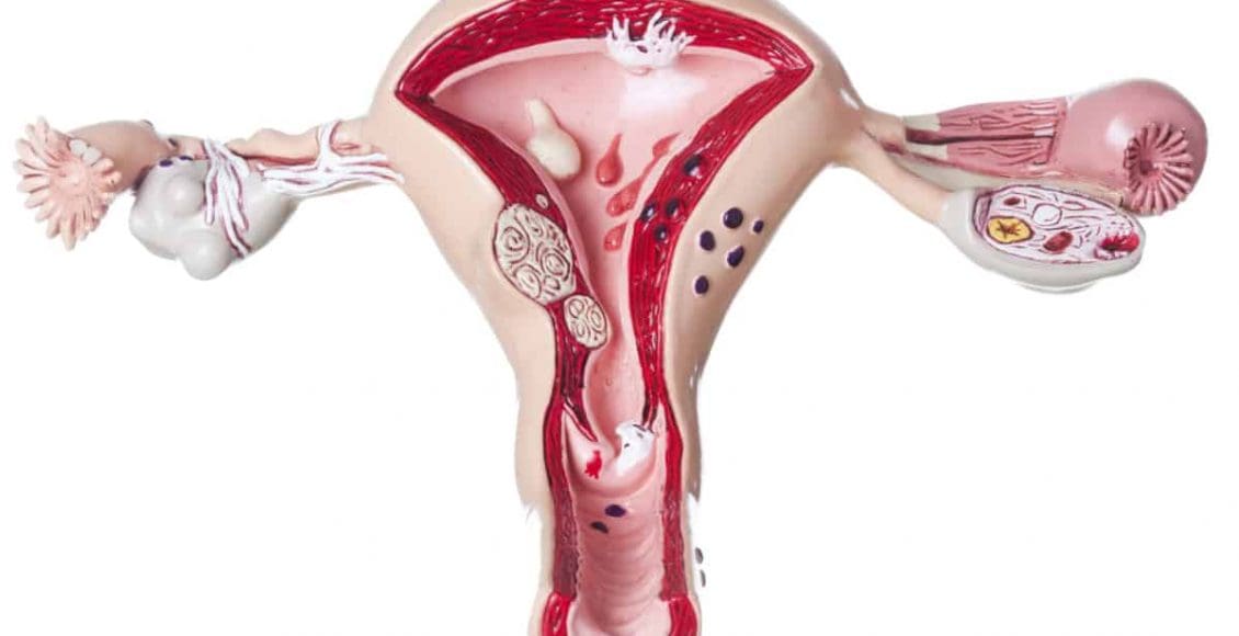 هل يحدث حمل بعد إزالة لحمية الرحم
