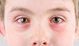 علاج التهاب العين في المنزل - موقع زيادة