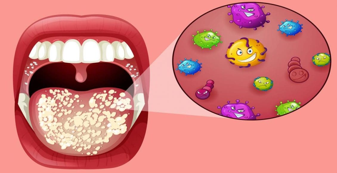 أدوية علاج فطريات الفم للكبار