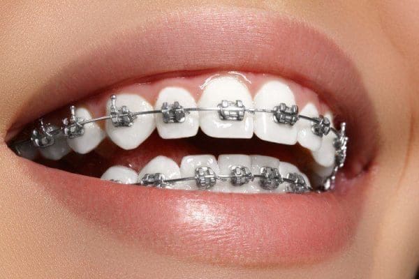 سعر تقويم الأسنان الفك العلوي فقط 2021