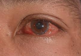علاج التهاب ملتحمة العين الفيروسي