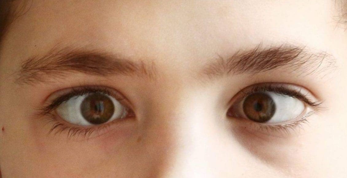 علاج انحراف العين البسيط عند الأطفال