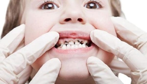 علاج تسوس الأسنان بالطب النبوي والأعشاب
