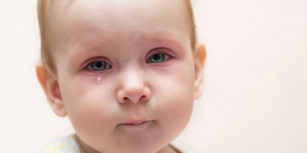 علاج حساسية العين عند الأطفال