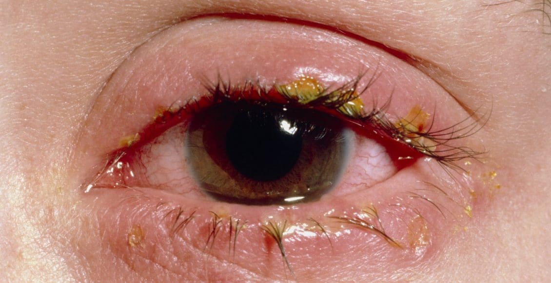 علاج قرص الناموس في العين