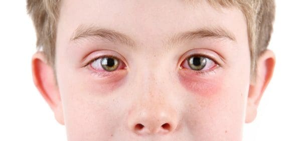 قطرة لعلاج احمرار العين عند الأطفال